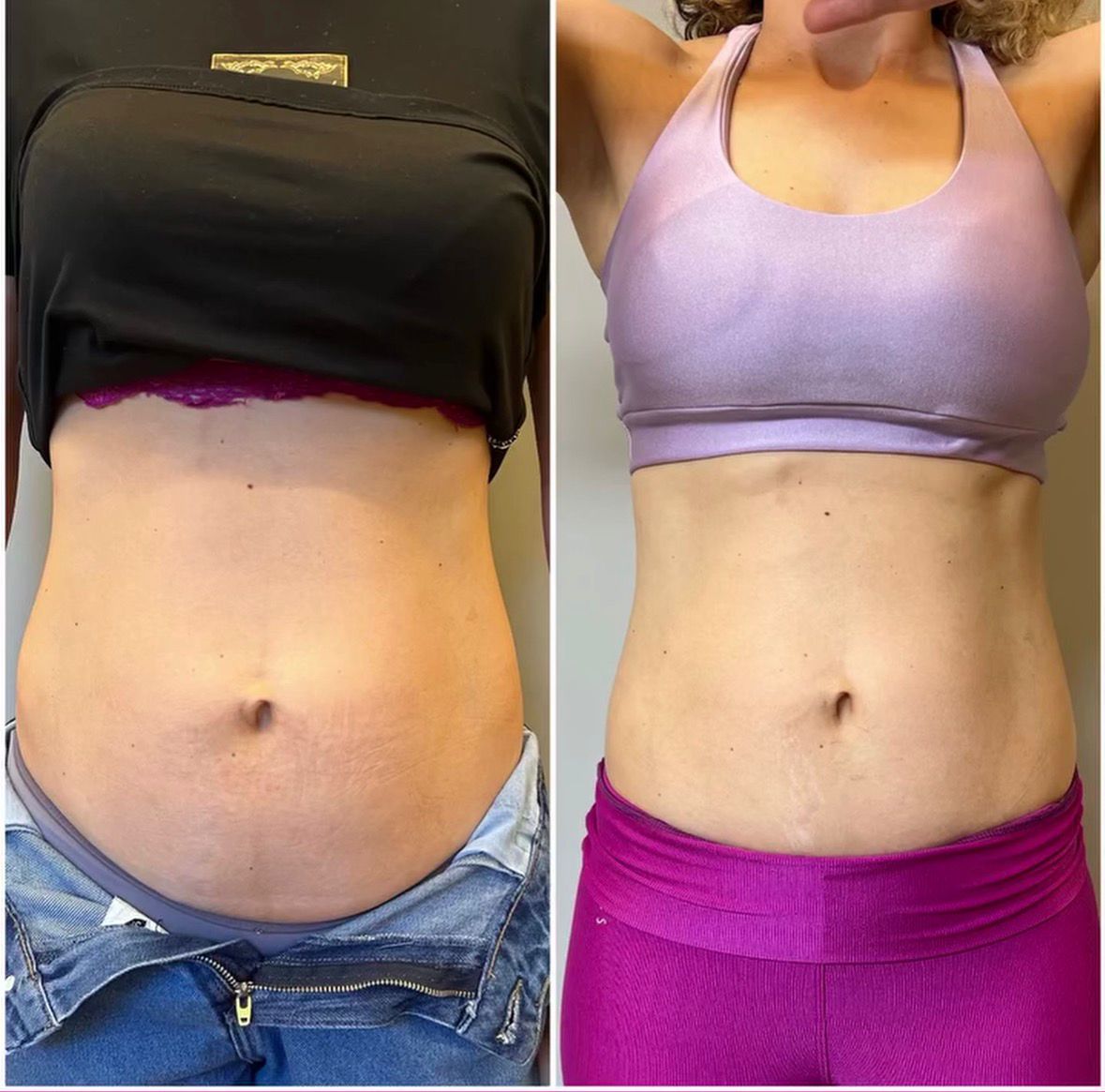 Resultado 1 - Antes e depois do tratamento de diástase