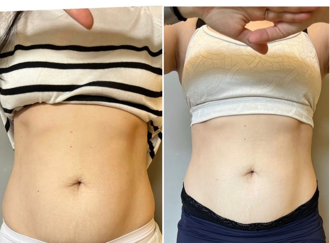Resultado 5 - Antes e depois do tratamento de diástase