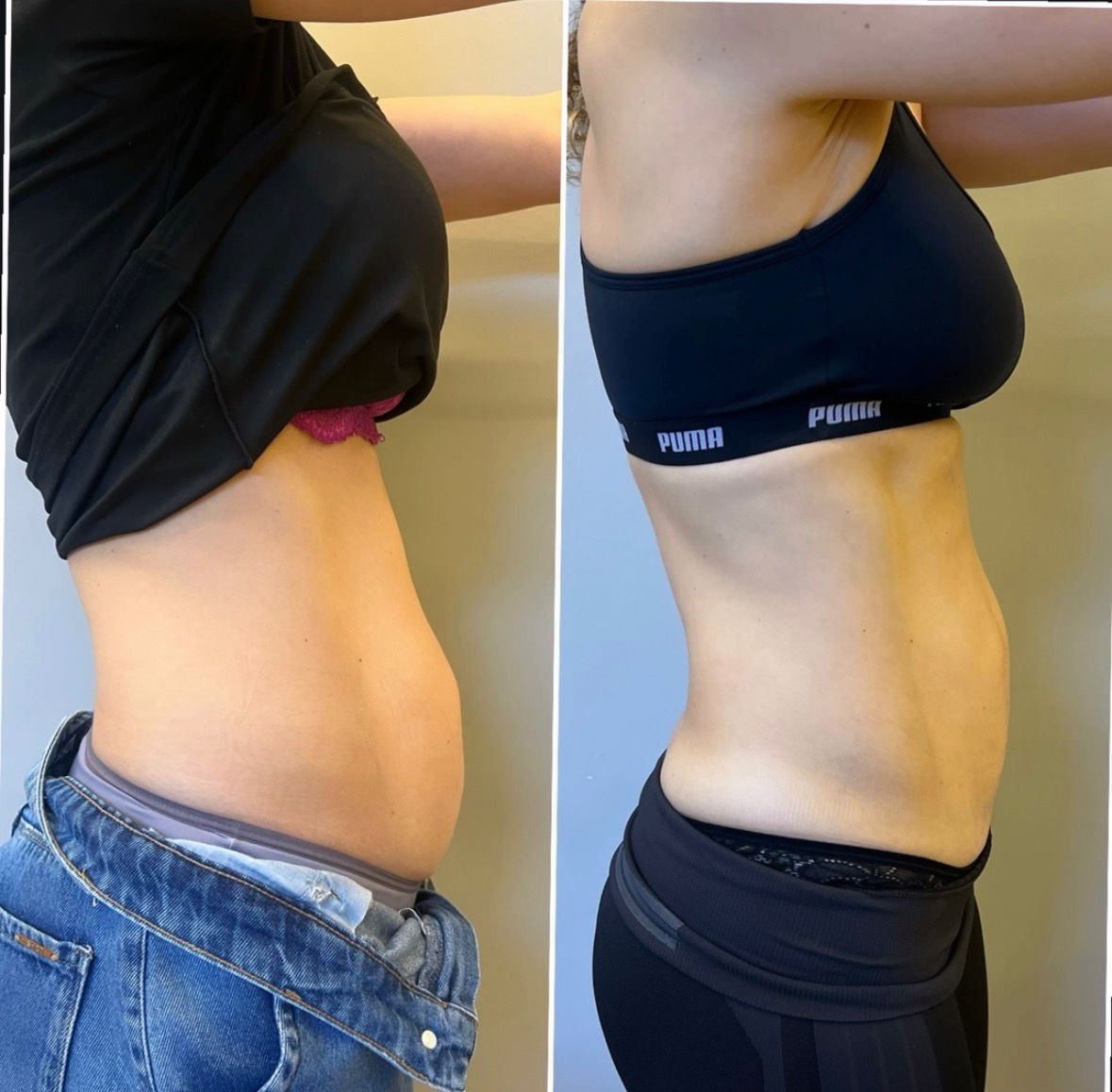 Resultado 2 - Antes e depois do tratamento de diástase