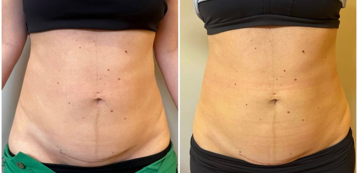 Resultado 6 - Antes e depois do tratamento de diástase