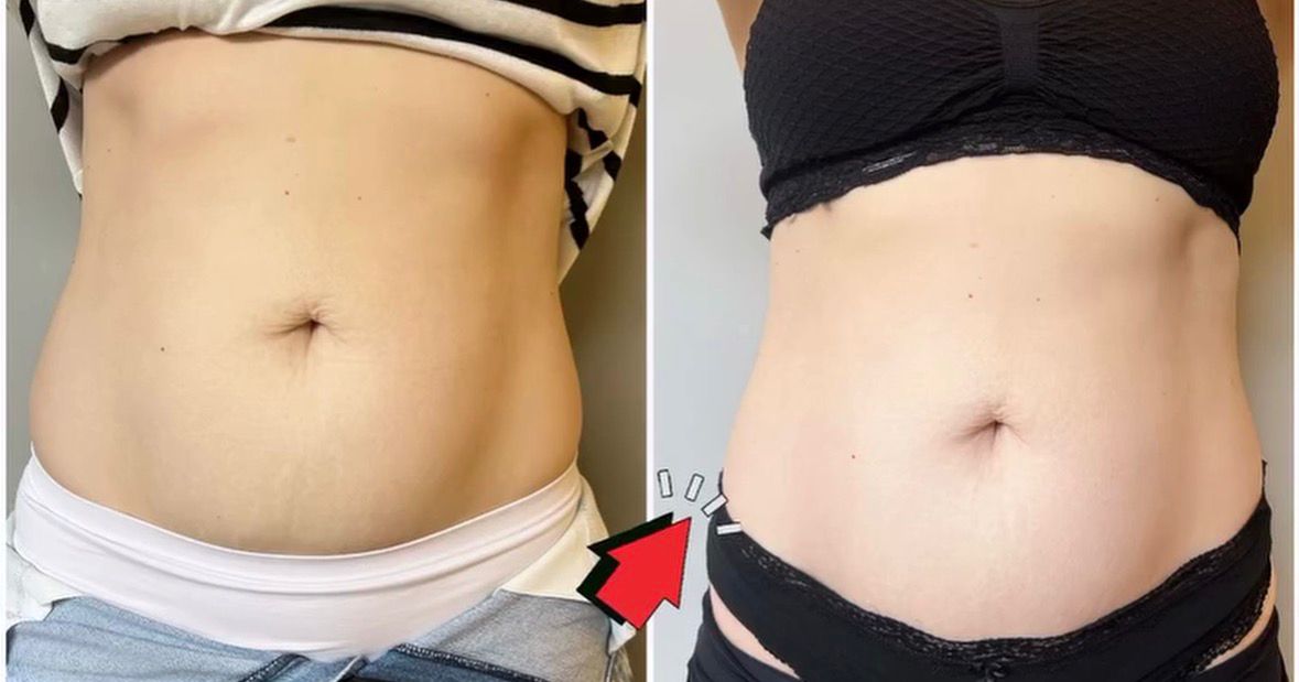 Resultado 4 - Antes e depois do tratamento de diástase