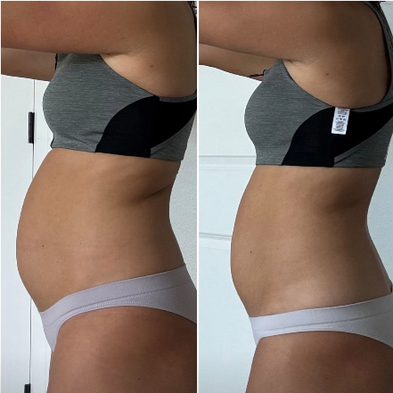 Resultado 3 - Antes e depois do tratamento de diástase