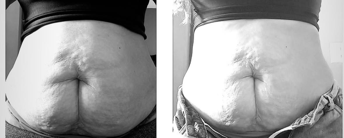 Resultado 7 - Antes e depois do tratamento de diástase