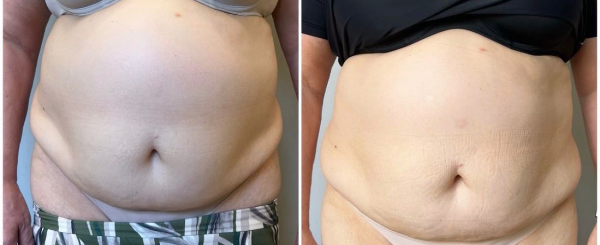 Resultado 8 - Antes e depois do tratamento de diástase
