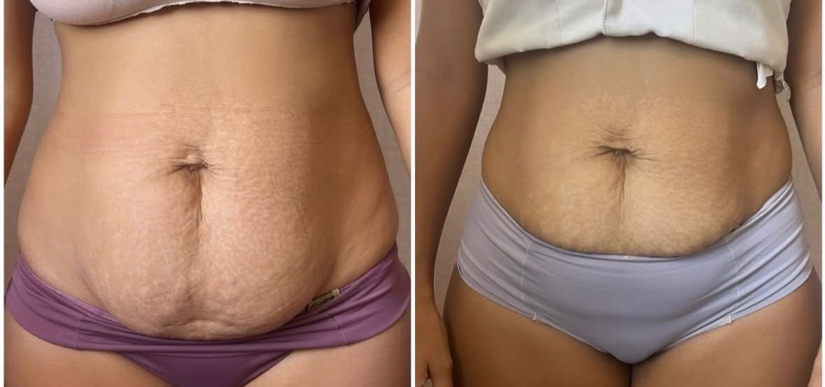 Resultado 9 - Antes e depois do tratamento de diástase